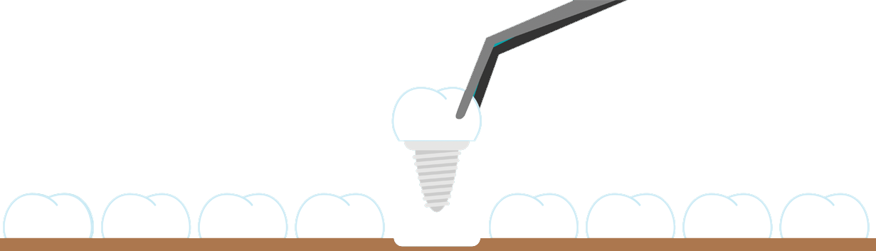 lake sammamish dental implants