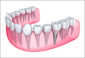 Issaquah Dental Implants